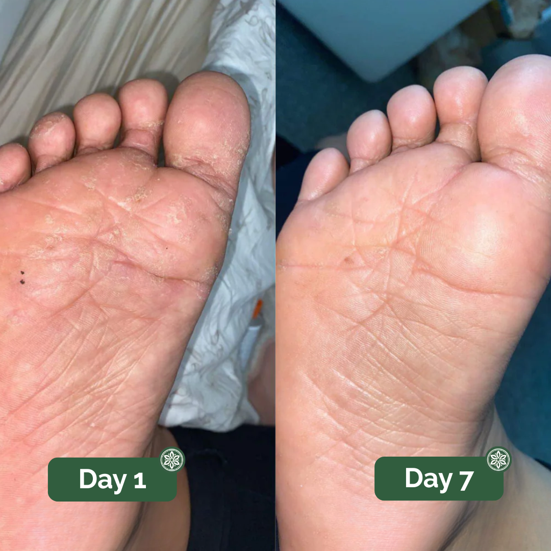 Athlete's foot on day 1 and day 7