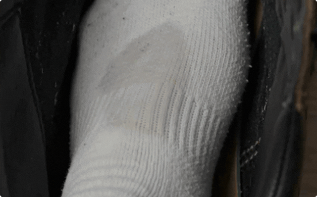 Treating Athlete's Foot Is Only Half The Battle