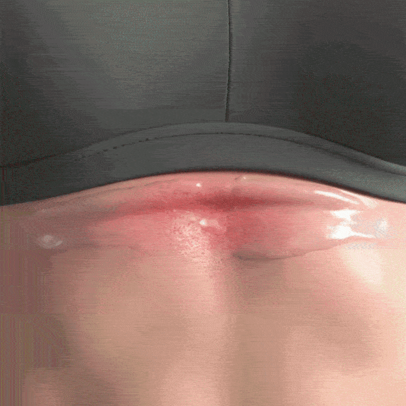 Fungal biofilm on skin